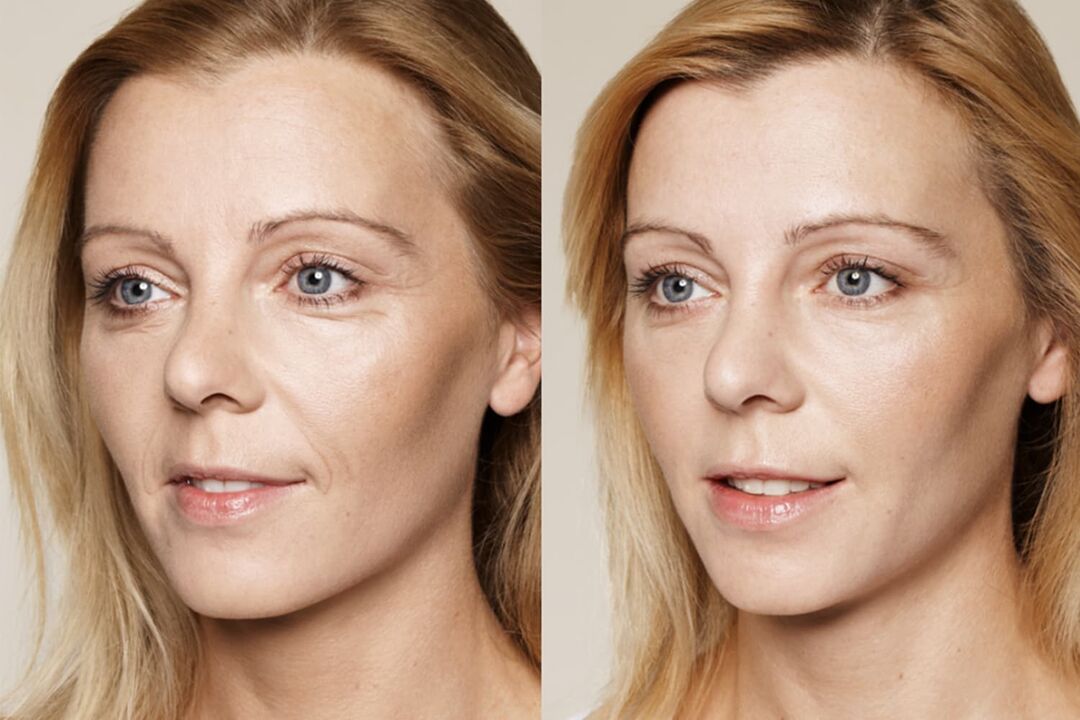 Erfahrungen mit der Anwendung vor und nach der Anwendung der intenskin-Creme von Valeria