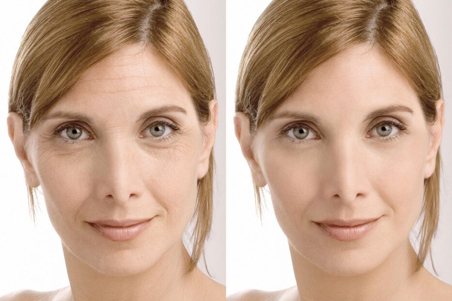 Erfahrungen mit der Anwendung vor und nach der Verwendung der intenskin-Creme von Milana